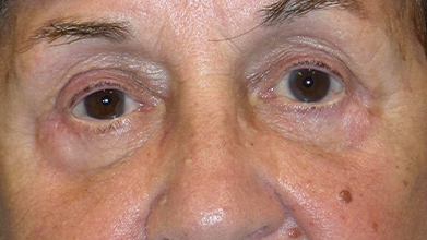 Eyelid Surgery Before and After | Princeton Plastic Surgeons