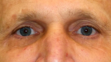 Eyelid Surgery Before and After | Princeton Plastic Surgeons