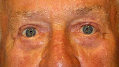 Eyelid Surgery Before and After | Princeton Plastic Surgeons