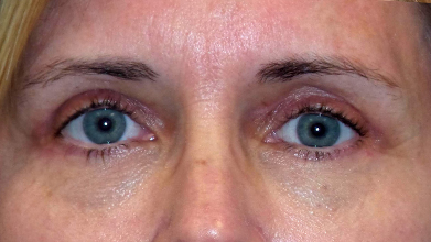 Eyelid Surgery Before and After | Princeton Plastic Surgeons