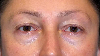 Eyelid Surgery Before and After | Princeton Plastic Surgeons