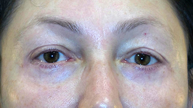 Eyelid Surgery Before and After | Princeton Plastic Surgeons