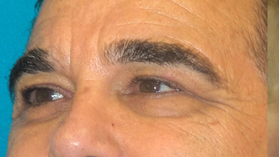 Eyelid Surgery Before and After | Princeton Plastic Surgeons