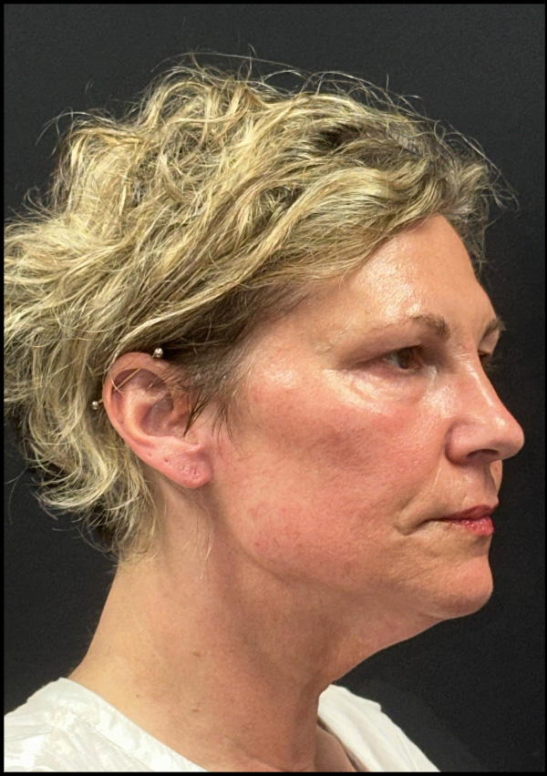 Facelift Before and After | Princeton Plastic Surgeons