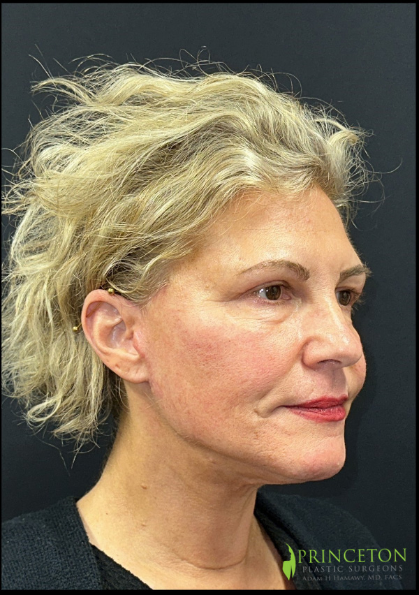 Facelift Before and After | Princeton Plastic Surgeons