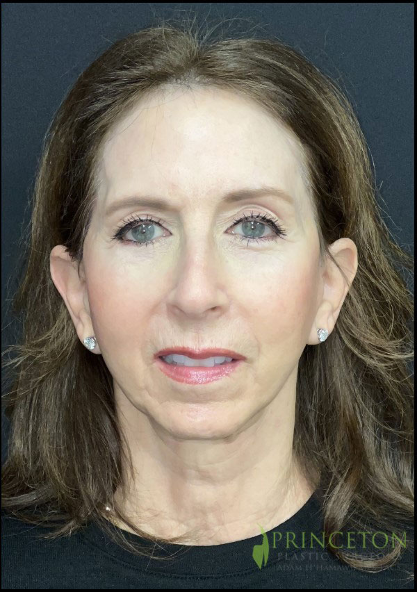 Facelift Before and After | Princeton Plastic Surgeons