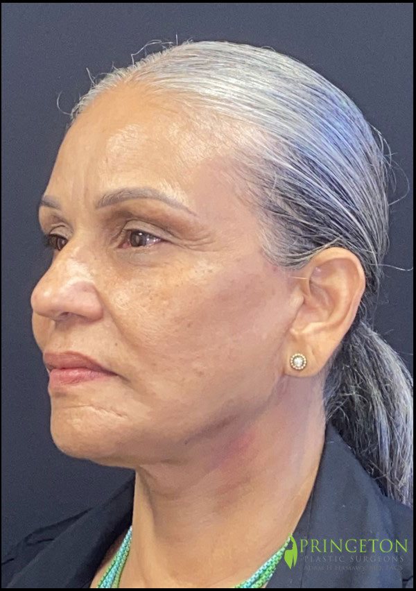 Facelift Before and After | Princeton Plastic Surgeons