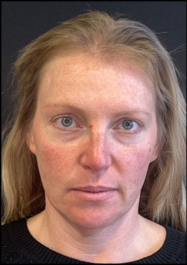 Facelift Before and After | Princeton Plastic Surgeons