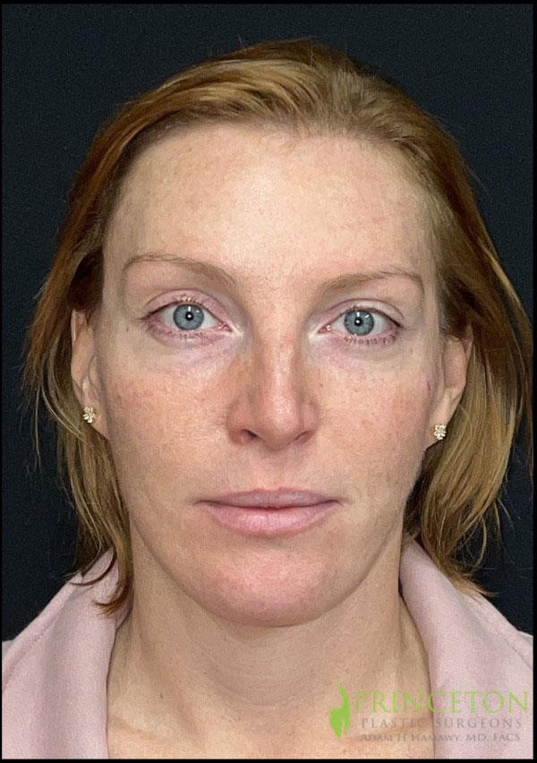 Facelift Before and After | Princeton Plastic Surgeons