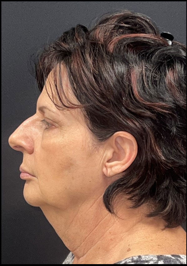 Facelift Before and After | Princeton Plastic Surgeons