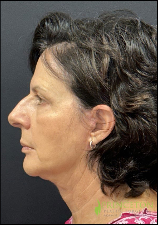 Facelift Before and After | Princeton Plastic Surgeons