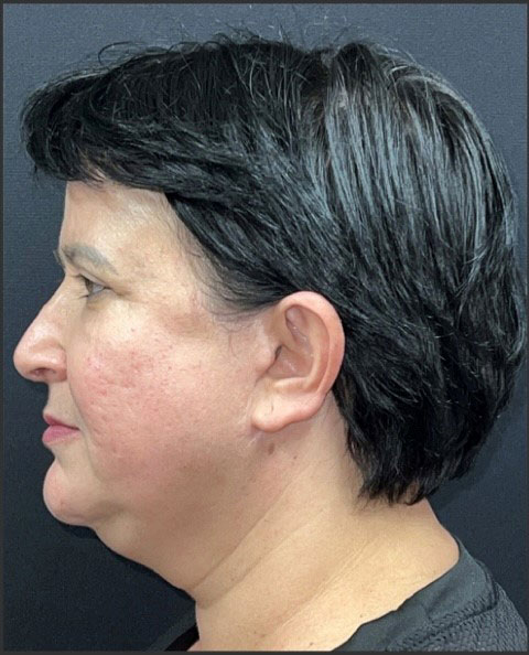 Facelift Before and After | Princeton Plastic Surgeons