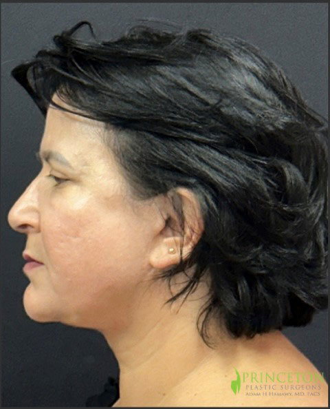 Facelift Before and After | Princeton Plastic Surgeons