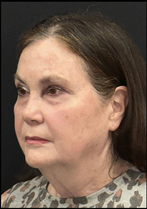 Facelift Before and After | Princeton Plastic Surgeons