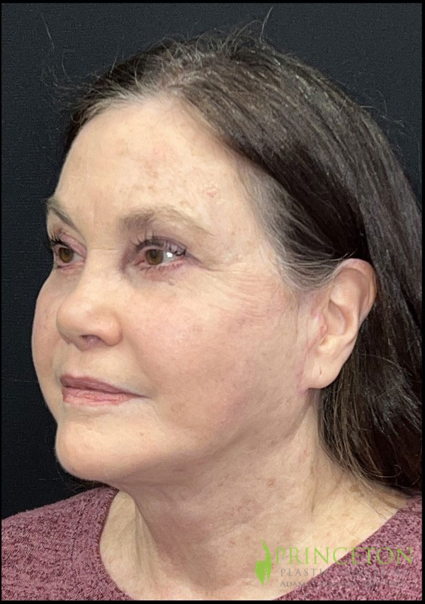 Facelift Before and After | Princeton Plastic Surgeons