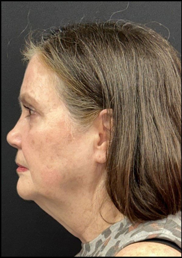 Facelift Before and After | Princeton Plastic Surgeons