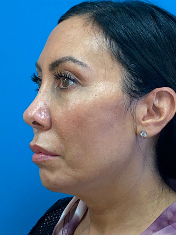 Facelift Before and After | Princeton Plastic Surgeons