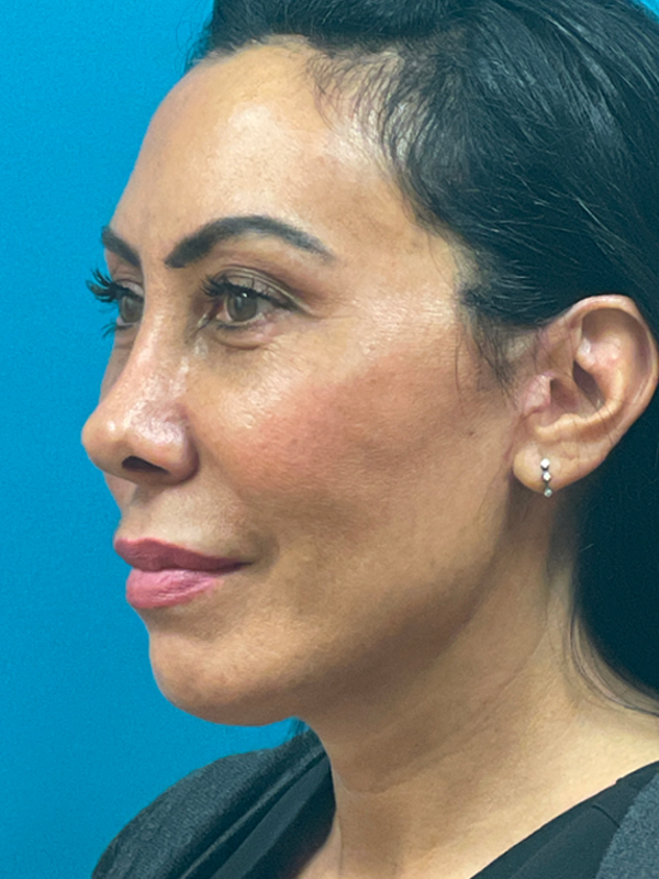 Facelift Before and After | Princeton Plastic Surgeons