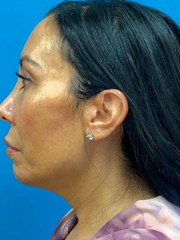 Facelift Before and After | Princeton Plastic Surgeons