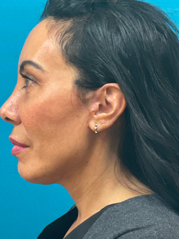 Facelift Before and After | Princeton Plastic Surgeons