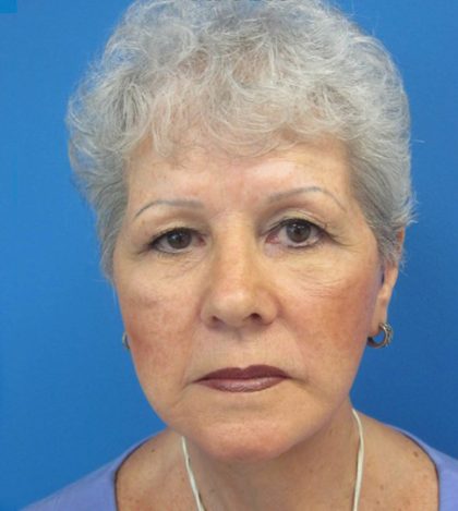 Facelift Before and After | Princeton Plastic Surgeons