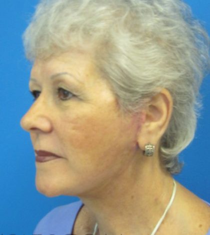 Facelift Before and After | Princeton Plastic Surgeons