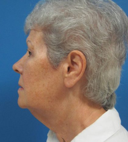 Facelift Before and After | Princeton Plastic Surgeons