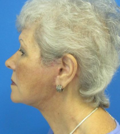 Facelift Before and After | Princeton Plastic Surgeons