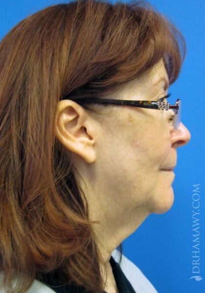 Facelift Before and After | Princeton Plastic Surgeons