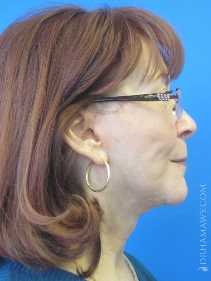 Facelift Before and After | Princeton Plastic Surgeons