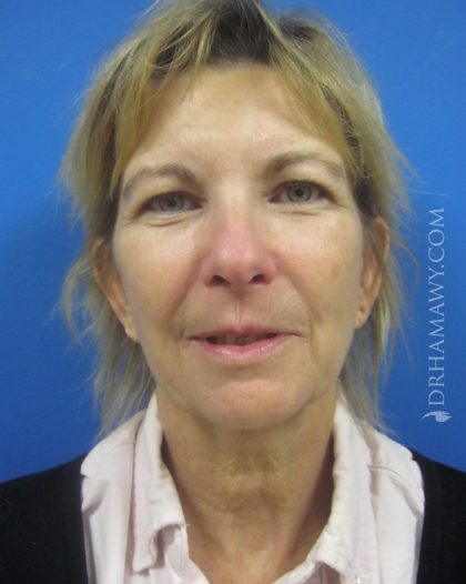 Facelift Before and After | Princeton Plastic Surgeons