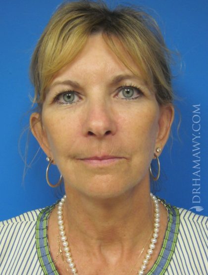 Facelift Before and After | Princeton Plastic Surgeons