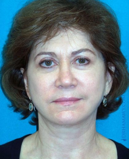 Facelift Before and After | Princeton Plastic Surgeons