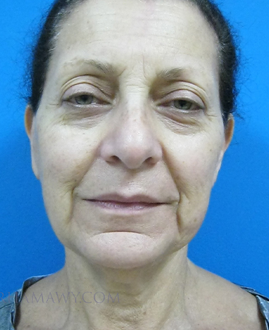 Facelift Before and After | Princeton Plastic Surgeons