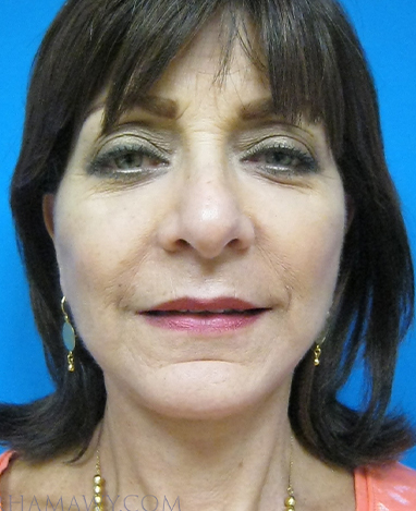 Facelift Before and After | Princeton Plastic Surgeons