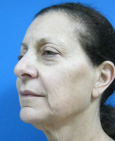 Facelift Before and After | Princeton Plastic Surgeons