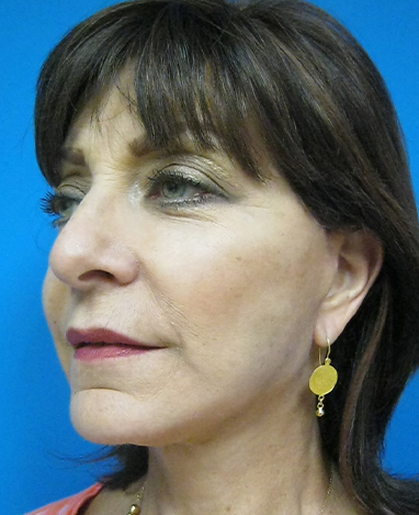 Facelift Before and After | Princeton Plastic Surgeons