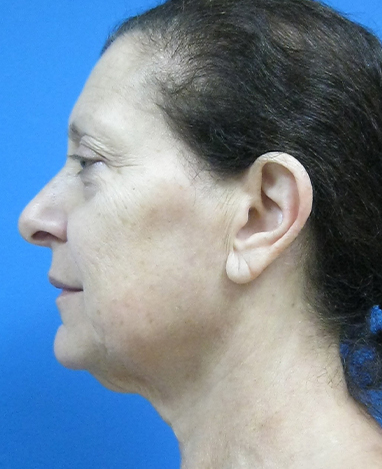 Facelift Before and After | Princeton Plastic Surgeons