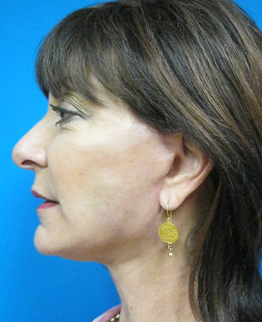 Facelift Before and After | Princeton Plastic Surgeons