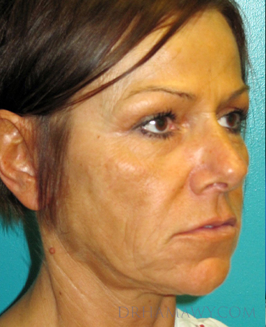 Facelift Before and After | Princeton Plastic Surgeons