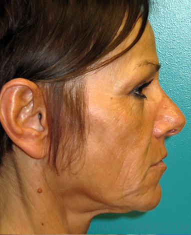 Facelift Before and After | Princeton Plastic Surgeons