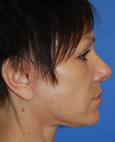 Facelift Before and After | Princeton Plastic Surgeons