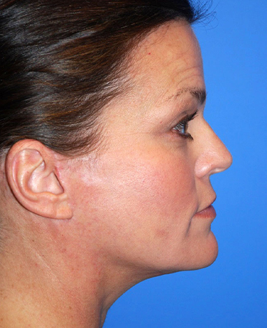 Facelift Before and After | Princeton Plastic Surgeons