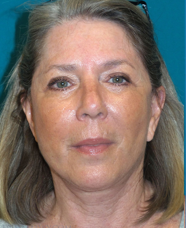 Facelift Before and After | Princeton Plastic Surgeons