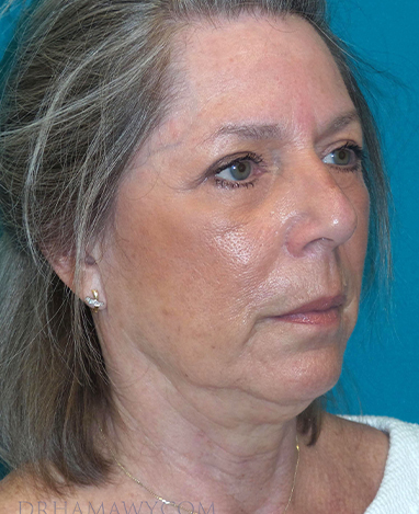 Facelift Before and After | Princeton Plastic Surgeons