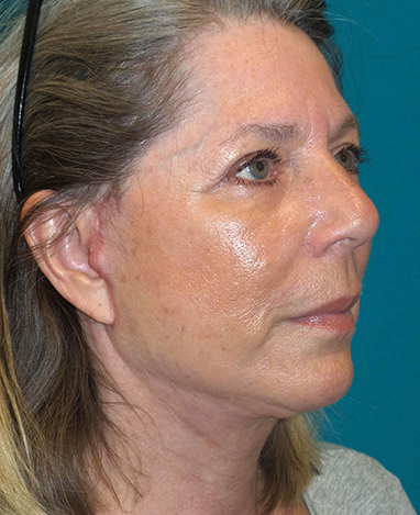 Facelift Before and After | Princeton Plastic Surgeons