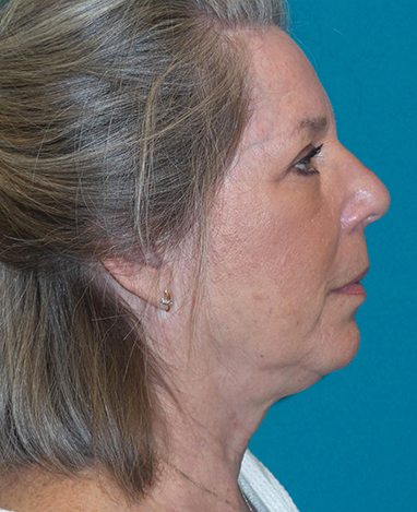 Facelift Before and After | Princeton Plastic Surgeons