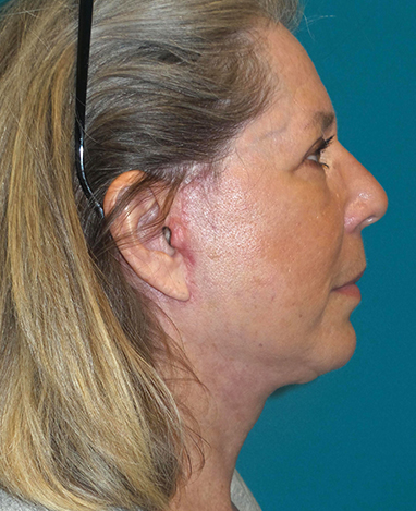 Facelift Before and After | Princeton Plastic Surgeons