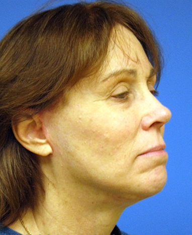 Facelift Before and After | Princeton Plastic Surgeons