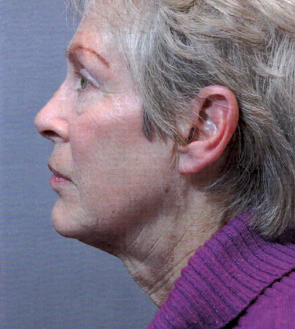 Facelift Before and After | Princeton Plastic Surgeons